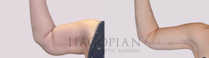 Before & After Arm Lift Case 258 Front Left View in Atlanta, GA