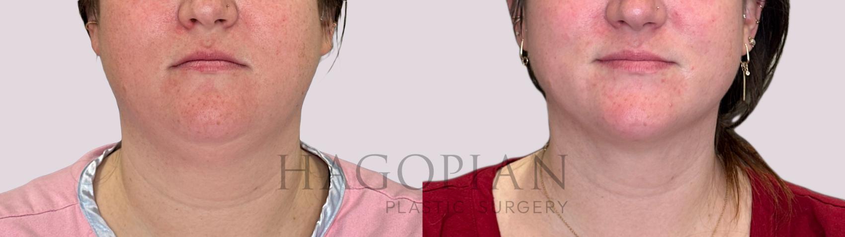 Before & After Chin Liposuction Case 227 Front View in Atlanta, GA