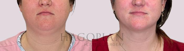 Before & After Chin Liposuction Case 227 Front View in Atlanta, GA