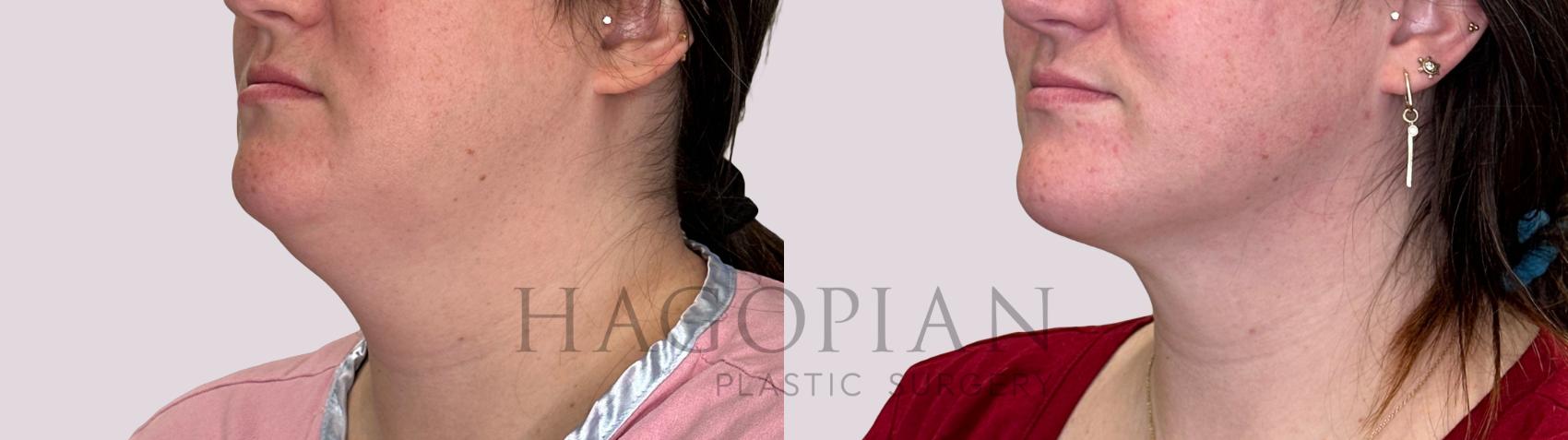 Before & After Chin Liposuction Case 227 Left Oblique View in Atlanta, GA