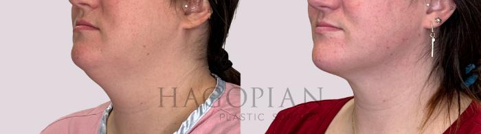 Before & After Chin Liposuction Case 227 Left Oblique View in Atlanta, GA