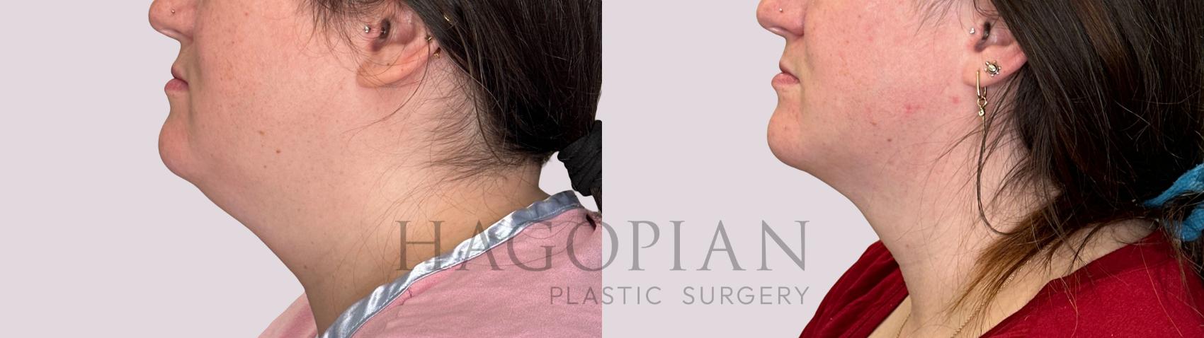 Before & After Chin Liposuction Case 227 Left Side View in Atlanta, GA