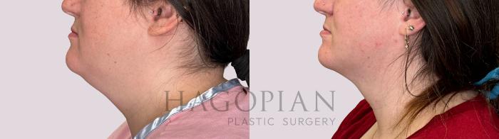 Before & After Chin Liposuction Case 227 Left Side View in Atlanta, GA