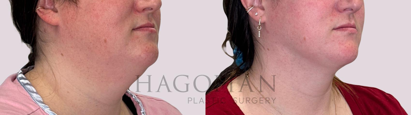 Before & After Chin Liposuction Case 227 Right Oblique View in Atlanta, GA