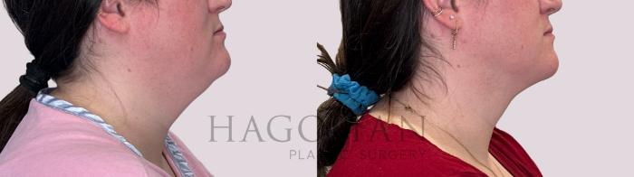 Before & After Chin Liposuction Case 227 Right Side View in Atlanta, GA