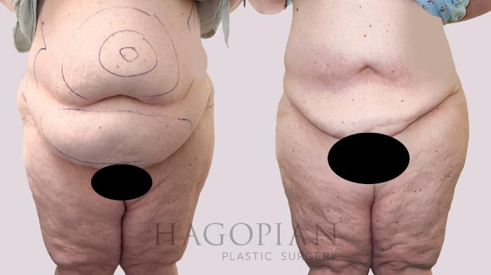 Before & After Liposuction Case 172 Front View in Atlanta, GA