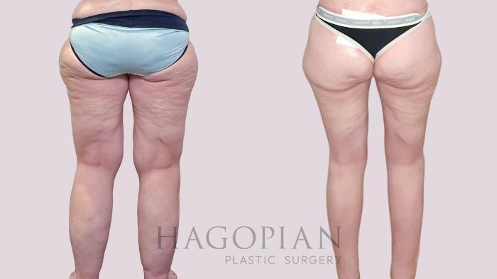 Before & After Thigh Lift Case 226 Back View in Atlanta, GA