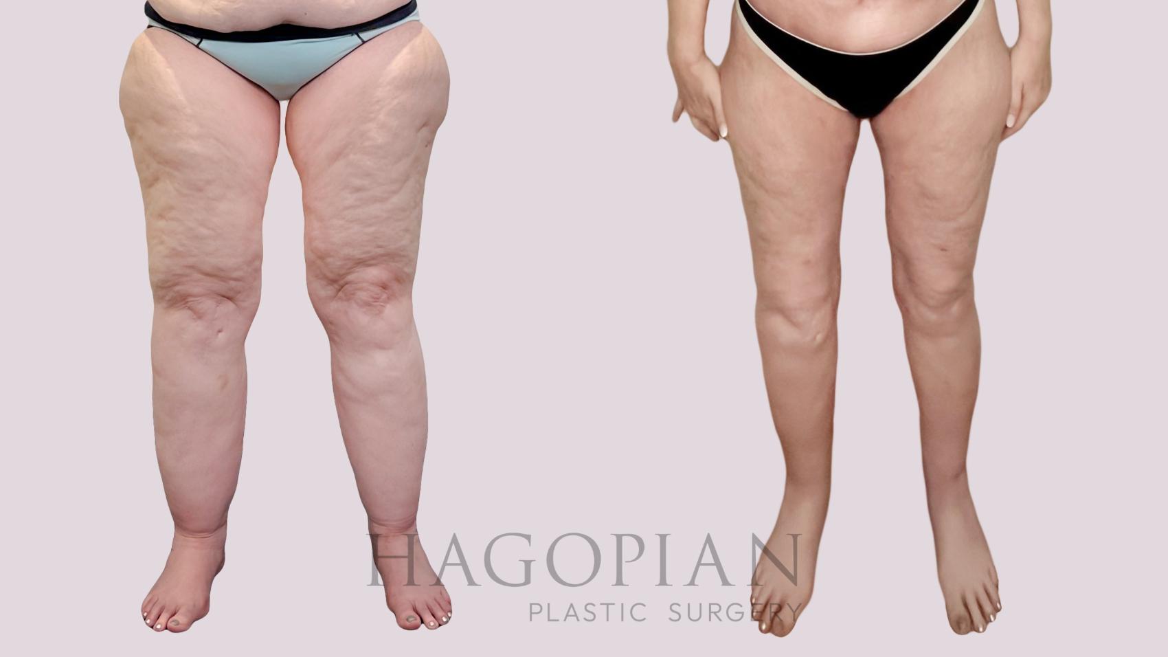 Before & After Thigh Lift Case 226 Front View in Atlanta, GA