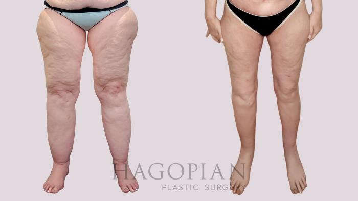 Before & After Thigh Lift Case 226 Front View in Atlanta, GA