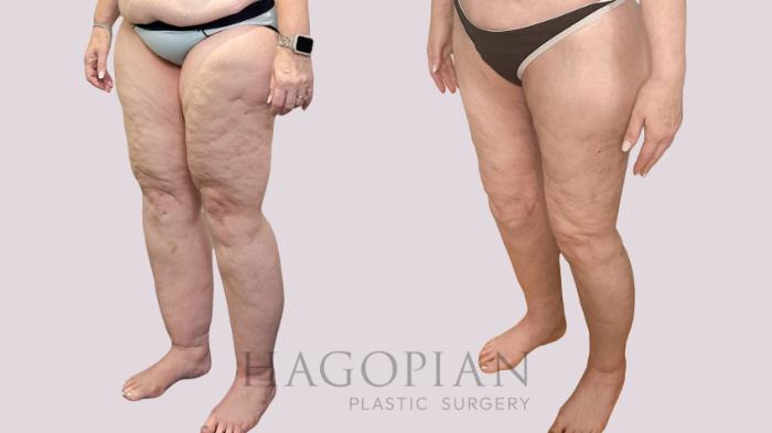 Before & After Thigh Lift Case 226 Left Oblique View in Atlanta, GA