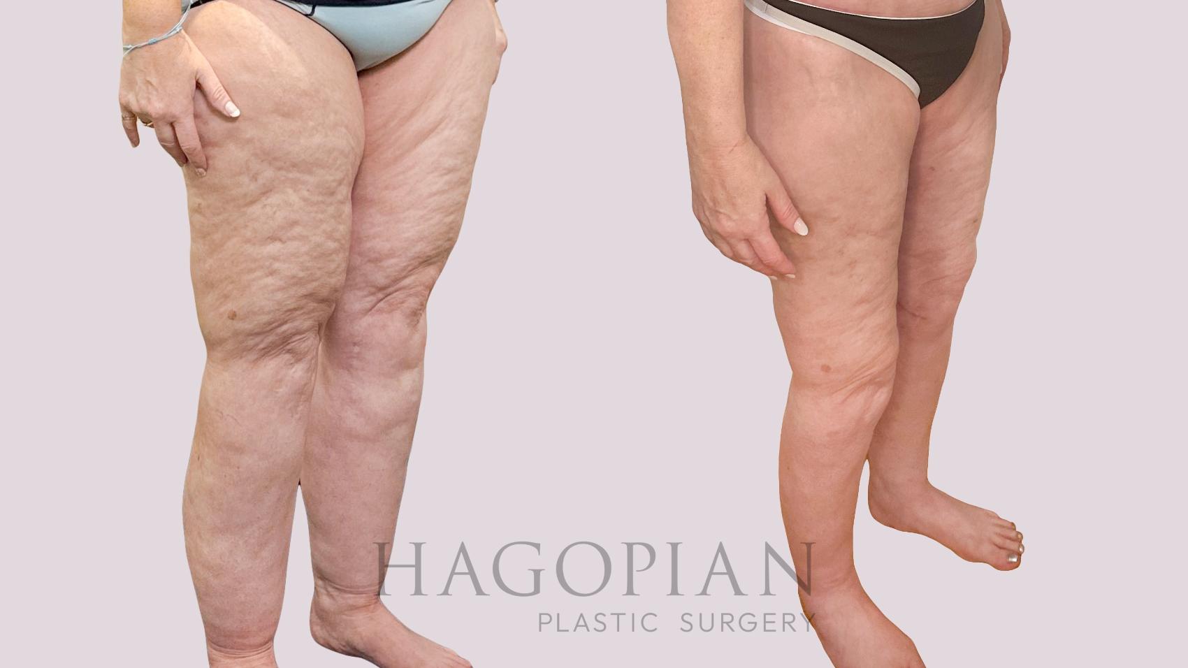 Before & After Thigh Lift Case 226 Right Oblique View in Atlanta, GA