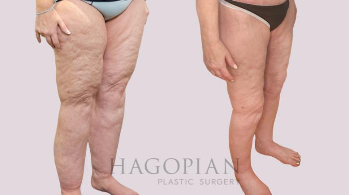 Before & After Thigh Lift Case 226 Right Oblique View in Atlanta, GA