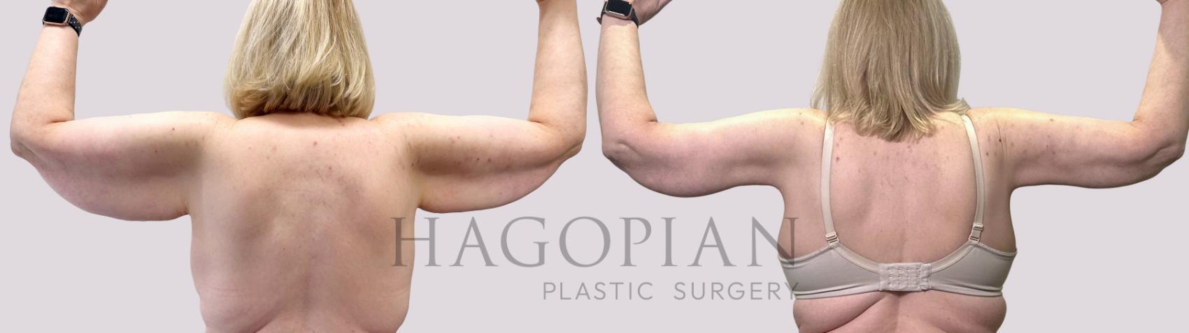Before & After Arm Lift Case 111 Back View in Atlanta, GA