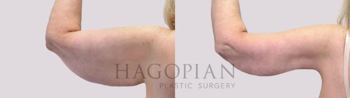 Before & After Arm Lift Case 111 Back Left View in Atlanta, GA