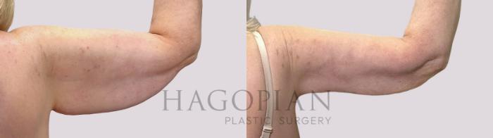 Before & After Arm Lift Case 111 Back Right View in Atlanta, GA