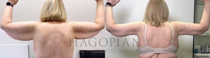 Before & After Arm Lift Case 111 Back View in Atlanta, GA