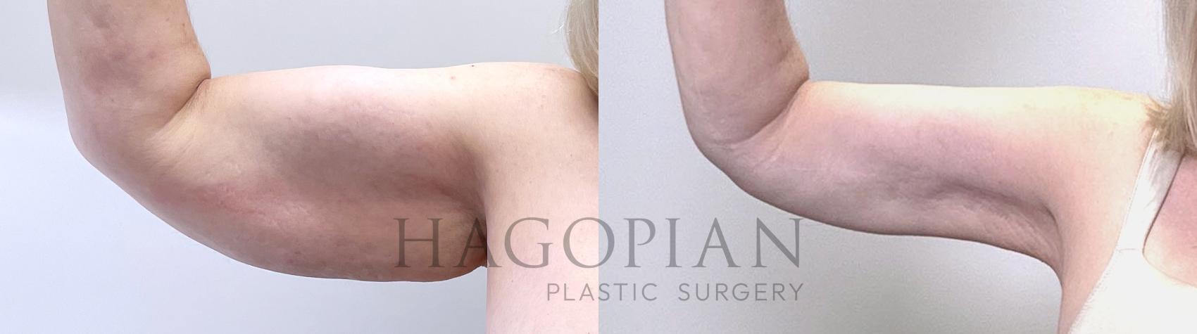 Before & After Arm Lift Case 111 Front View in Atlanta, GA