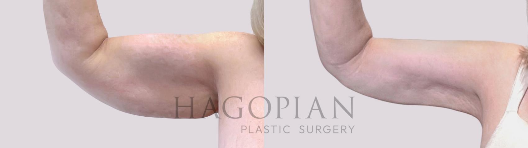 Before & After Arm Lift Case 111 Front Left View in Atlanta, GA