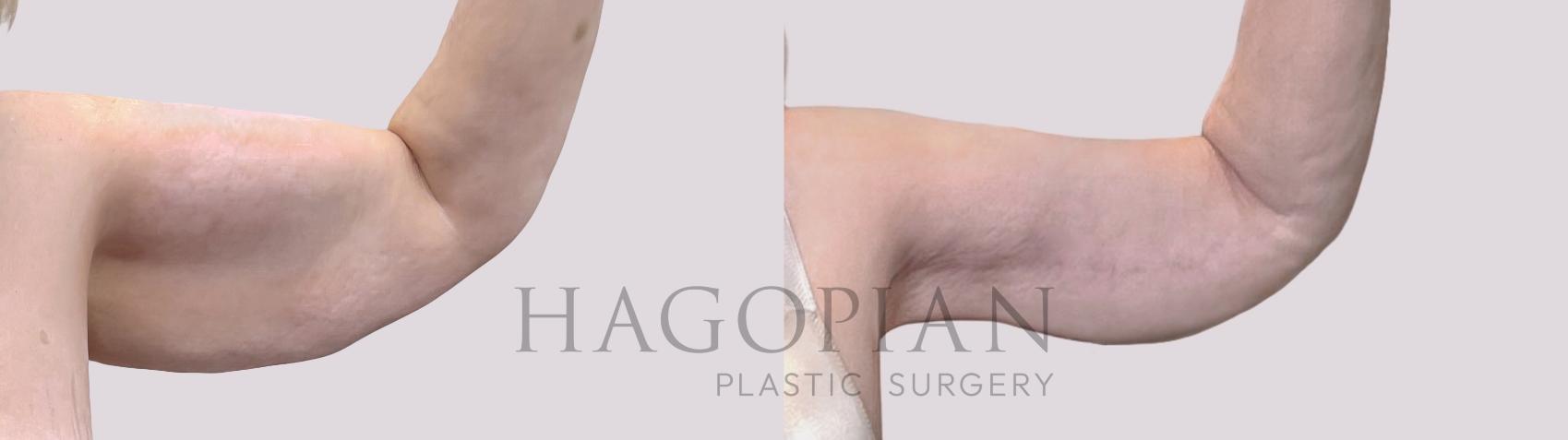 Before & After Arm Lift Case 111 Front Right View in Atlanta, GA