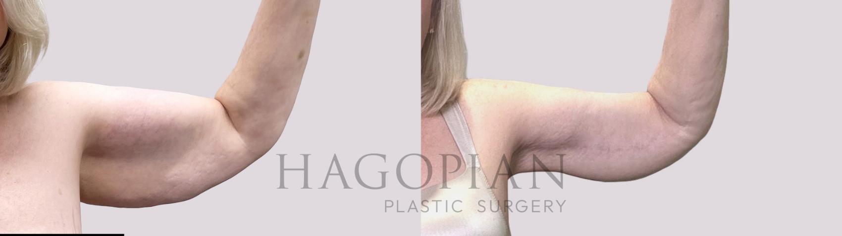 Before & After Arm Lift Case 111 Right Side View in Atlanta, GA