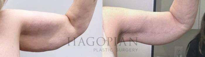 Before & After Arm Lift Case 111 Right Side View in Atlanta, GA