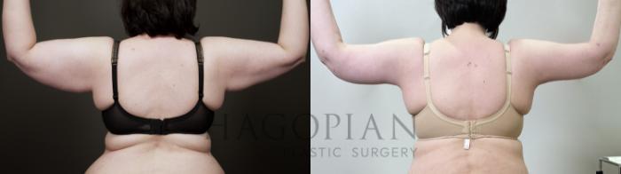 Before & After Arm Lift Case 120 Back View in Atlanta, GA