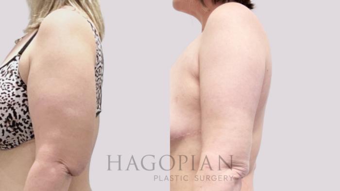 Before & After Arm Lift Case 132 Back View in Atlanta, GA