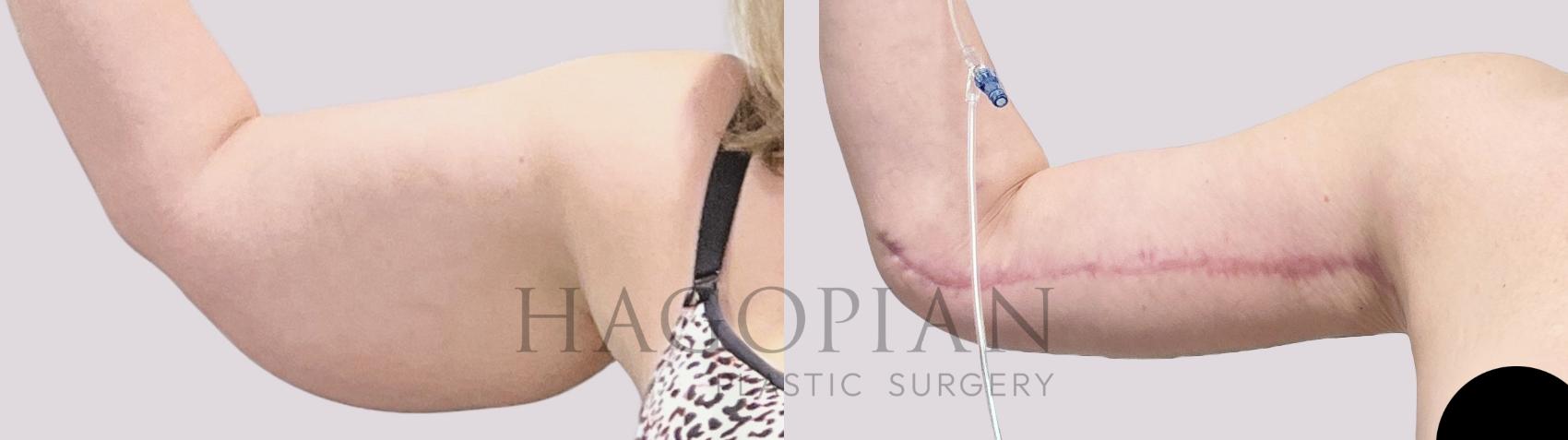 Before & After Arm Lift Case 132 Front View in Atlanta, GA