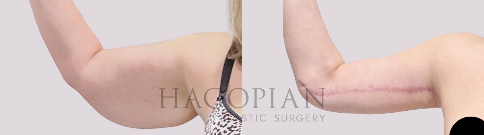 Before & After Arm Lift Case 132 Front Left View in Atlanta, GA