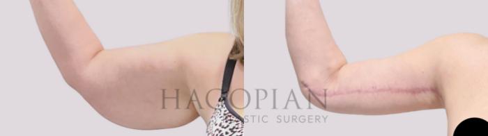 Before & After Arm Lift Case 132 Front Left View in Atlanta, GA