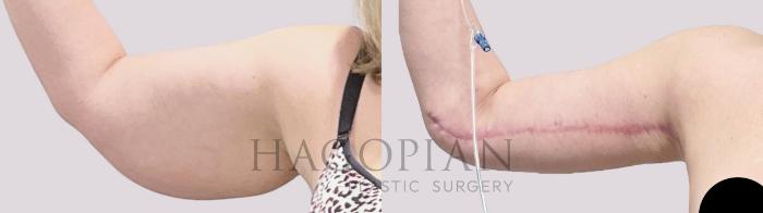 Before & After Arm Lift Case 132 Front View in Atlanta, GA