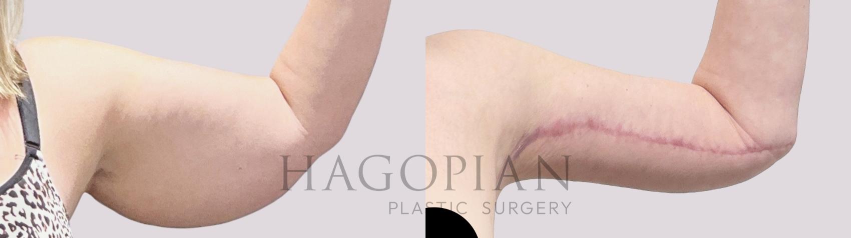 Before & After Arm Lift Case 132 Left Side View in Atlanta, GA