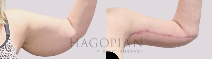 Before & After Arm Lift Case 132 Left Side View in Atlanta, GA