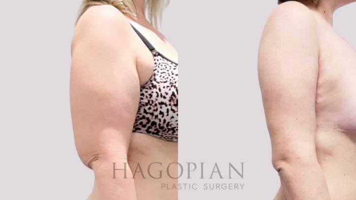 Before & After Arm Lift Case 132 Right Side View in Atlanta, GA