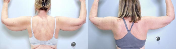 Before & After Arm Lift Case 135 Back View in Atlanta, GA