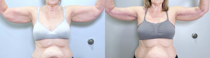 Before & After Lipedema Surgery Case 135 Front View in Atlanta, GA