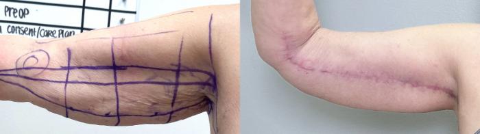 Before & After Arm Lift Case 135 Right Side View in Atlanta, GA