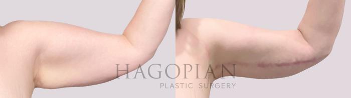 Before & After Arm Lift Case 142 Left Side View in Atlanta, GA