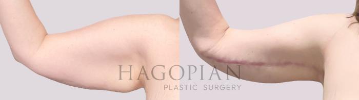 Before & After Arm Lift Case 142 Right Side View in Atlanta, GA