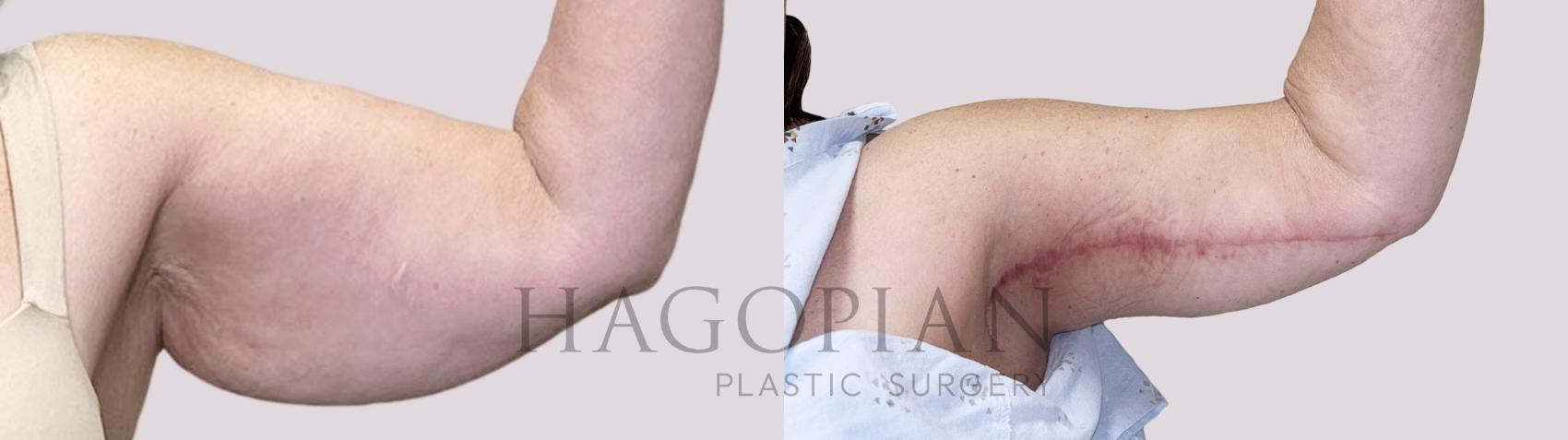 Before & After Arm Lift Case 149 Left Side View in Atlanta, GA
