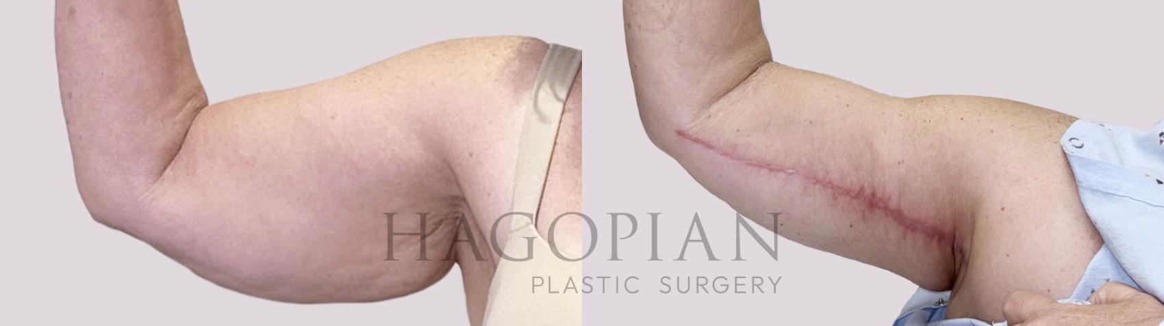 Before & After Arm Lift Case 149 Right Side View in Atlanta, GA