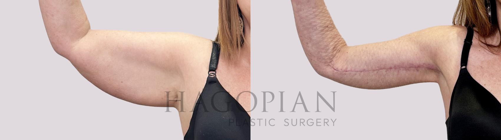 Before & After Arm Lift Case 152 Front View in Atlanta, GA
