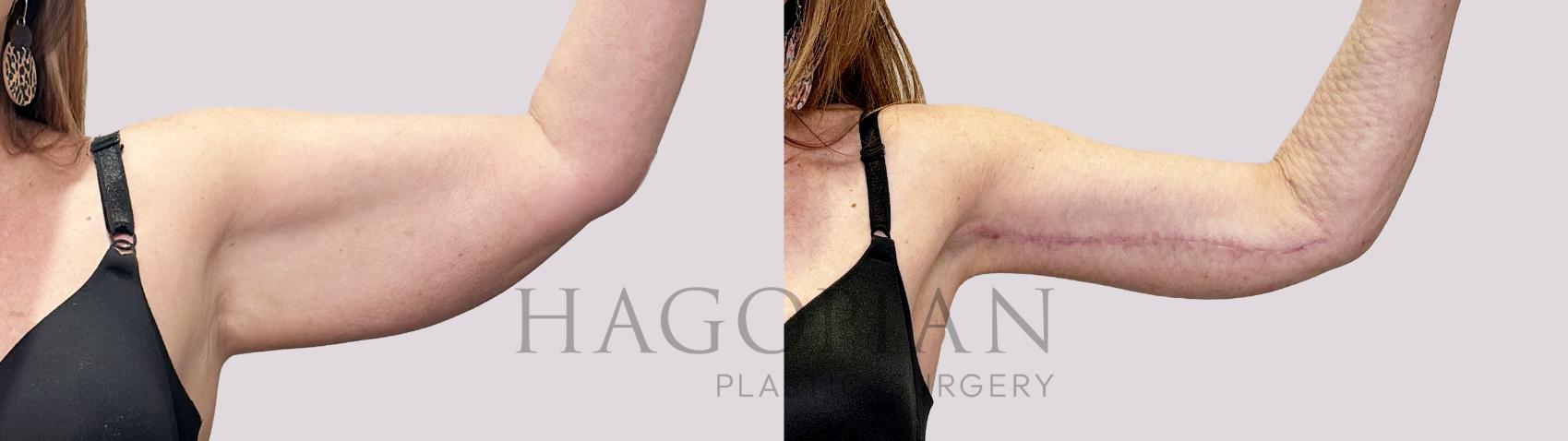 Before & After Arm Lift Case 152 Left Side View in Atlanta, GA