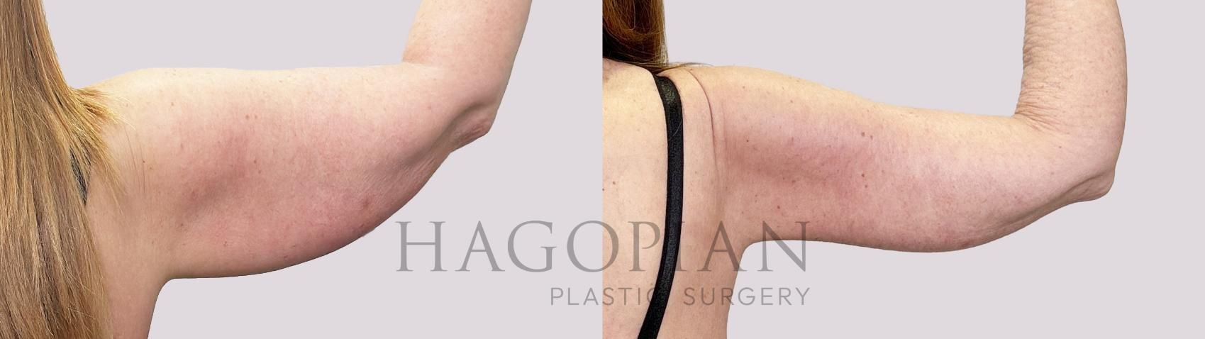 Before & After Arm Lift Case 152 Right Side View in Atlanta, GA