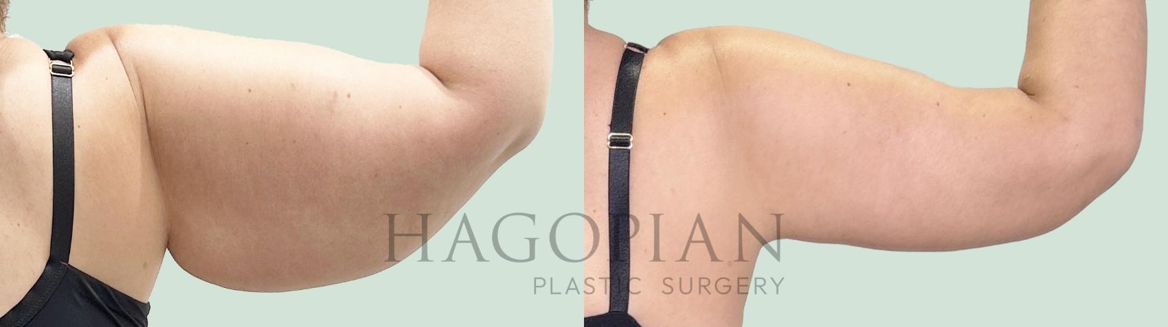 Before & After Arm Lift Case 157 Back View in Atlanta, GA