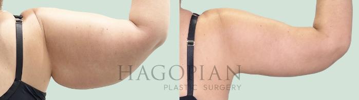 Before & After Arm Lift Case 157 Back View in Atlanta, GA
