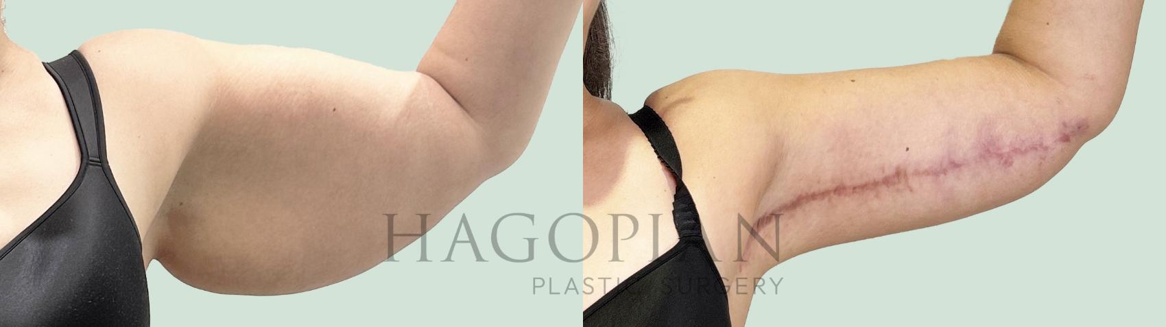 Before & After Arm Lift Case 157 Front View in Atlanta, GA