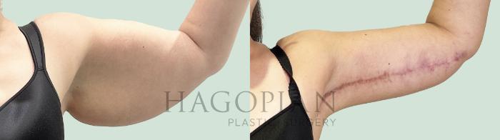 Before & After Arm Lift Case 157 Front View in Atlanta, GA