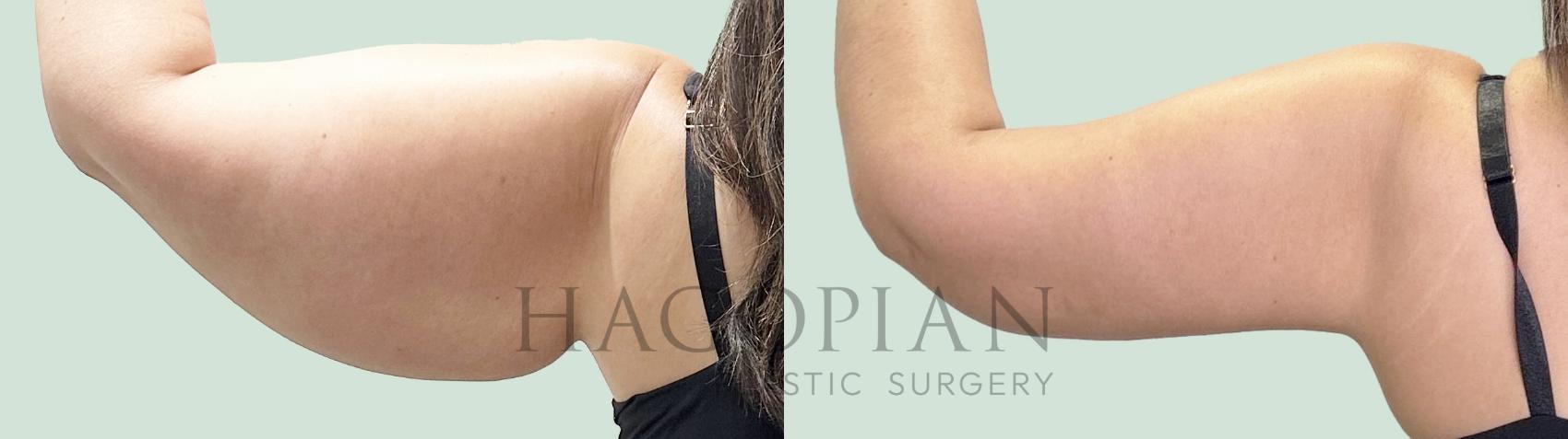 Before & After Arm Lift Case 157 Left Side View in Atlanta, GA
