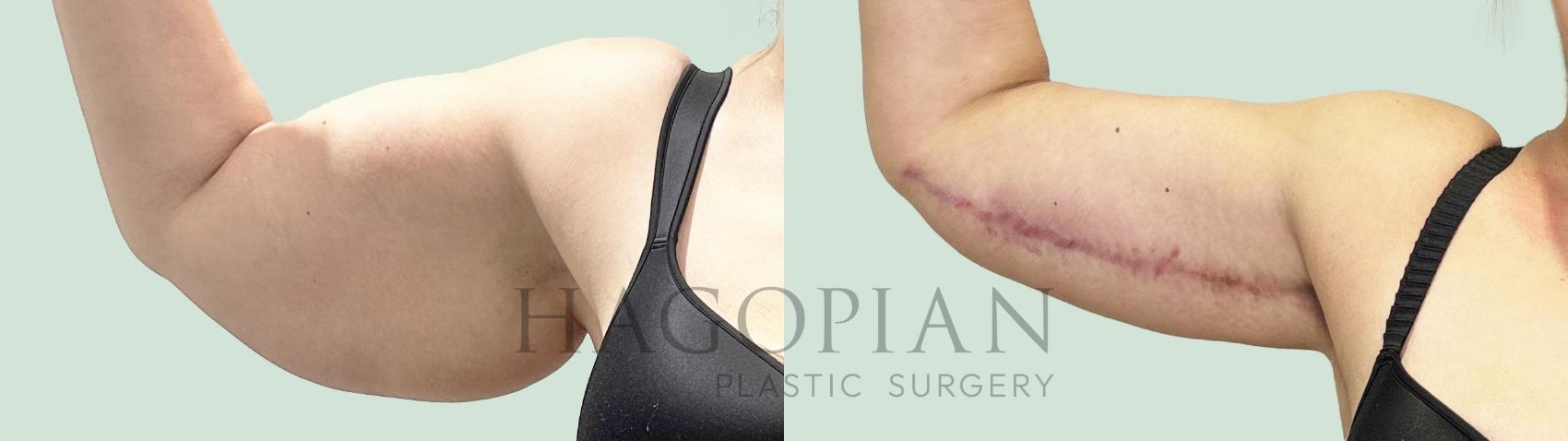 Before & After Arm Lift Case 157 Right Side View in Atlanta, GA
